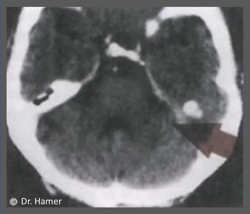 Câncer de pulmão - tomografia cerebral com anéis concêntricos