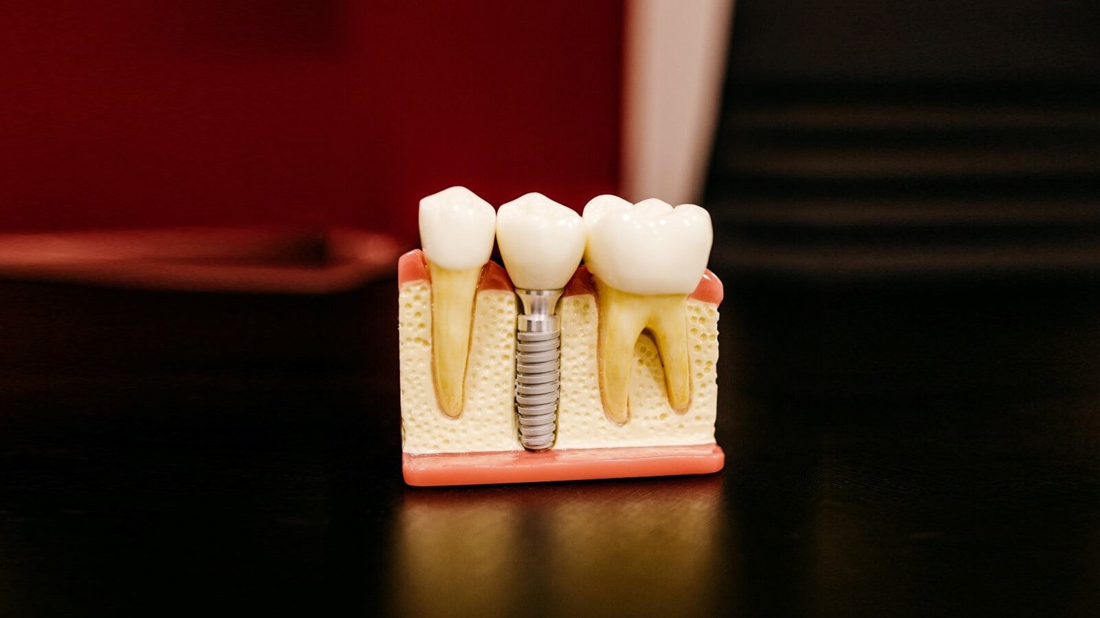 Implantes dentários - avaliação dos efeitos por Bdort