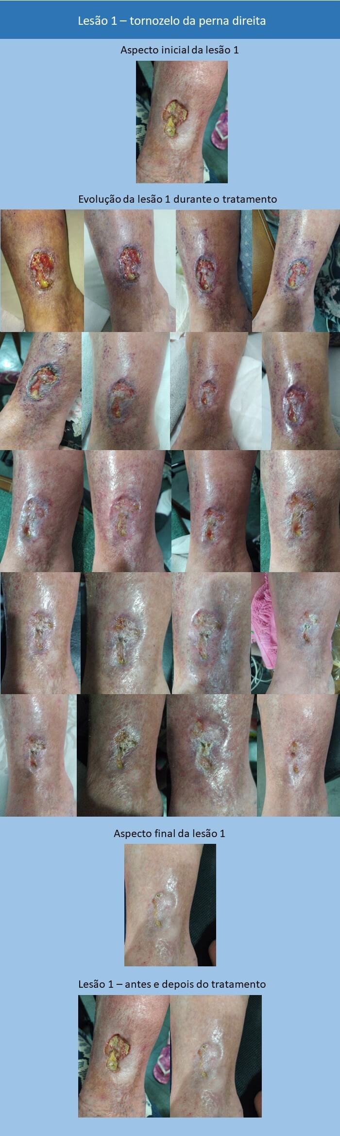 Feridas nas pernas - tratamento com laser-ledterapia