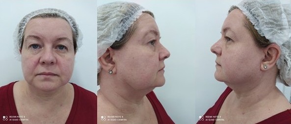 Cirurgia facial com fios de PDO
