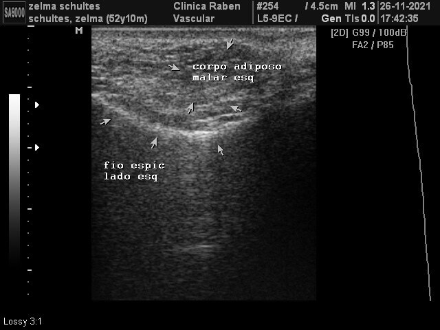 Cirurgia facial com fios de PDO – ultrassonografia