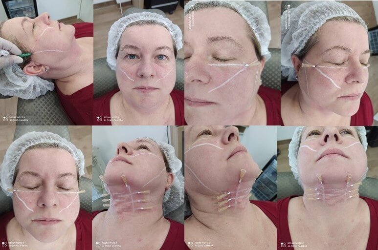 Cirurgia facial com fios de PDO