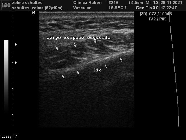 Cirurgia facial com fios de PDO - ultrassonografia