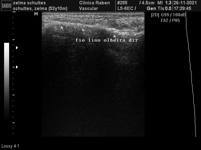Cirurgia facial com fios de PDO – ultrassonografia
