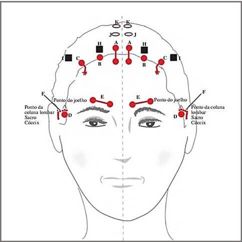 Craniopuntura de Yamamoto - pontos básicos