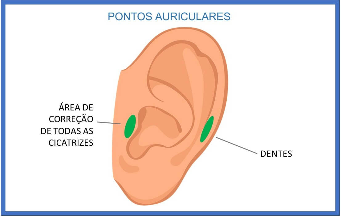 Pontos reflexos na orelha para dor de cabeça